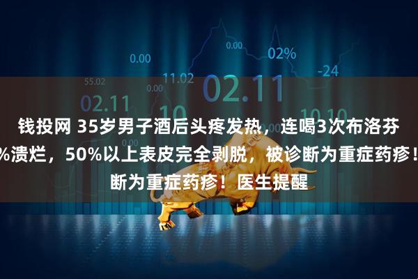 钱投网 35岁男子酒后头疼发热，连喝3次布洛芬后全身95%溃烂，50%以上表皮完全剥脱，被诊断为重症药疹！医生提醒
